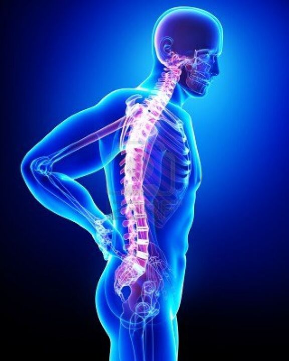 Ľudská chrbtica postihnutá osteochondrózou